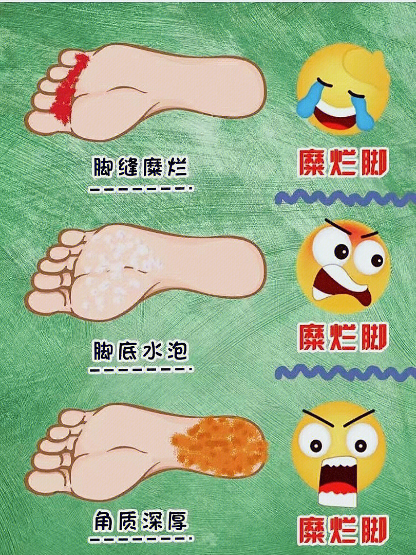 香港脚怎么治最好最快图片