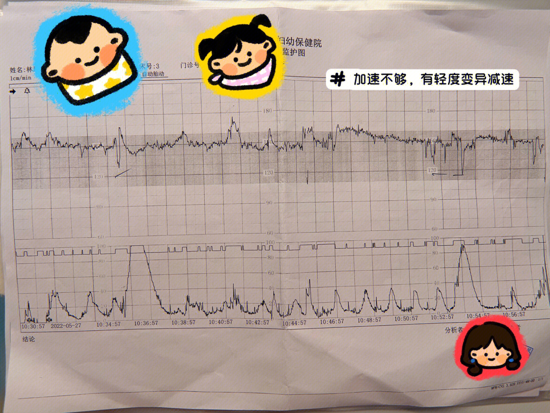 胎心监护合格图片图片
