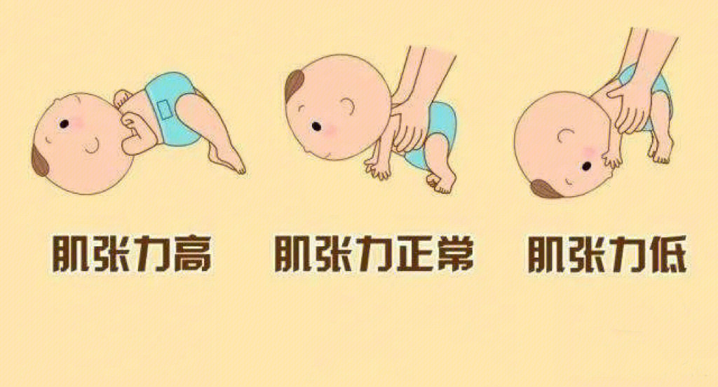 婴儿背部肌张力高图片图片