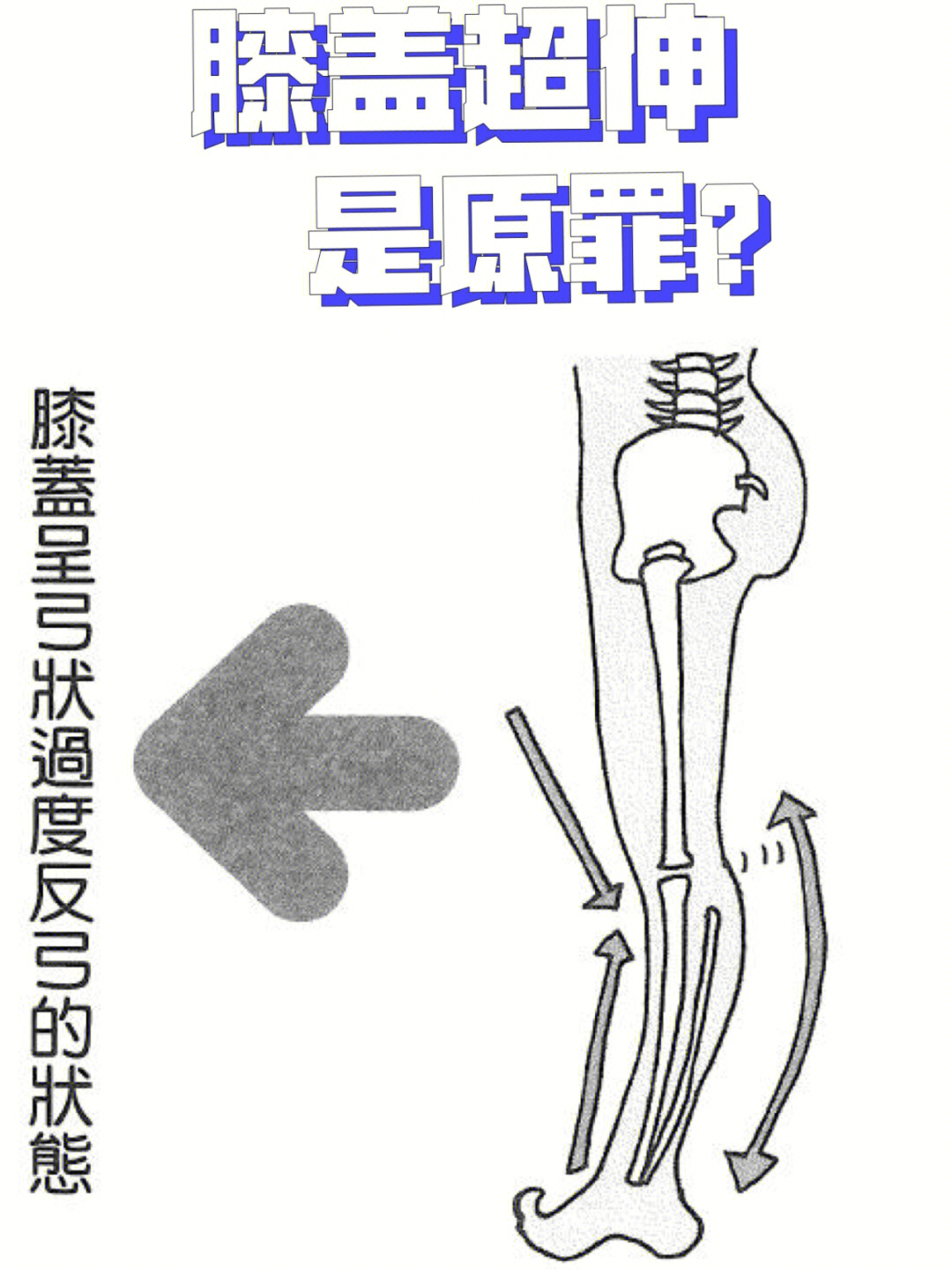 膝盖超伸是膝盖内旋的原罪解决方案附图