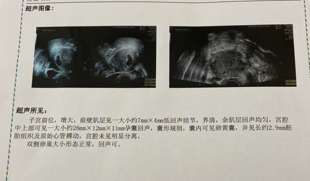 子宫前后壁区分超声图图片