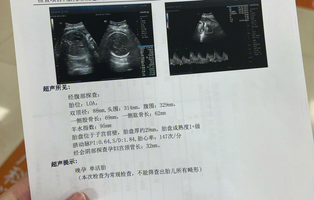 怀孕37周胎儿彩超图片