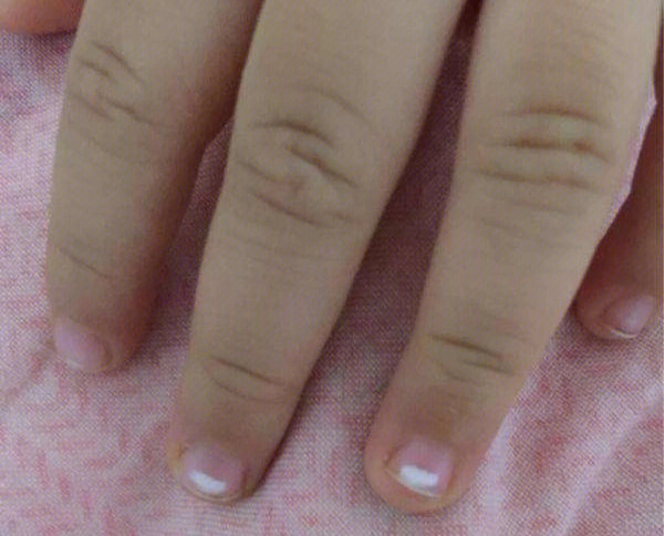 指甲白色蛔虫卵图片图片
