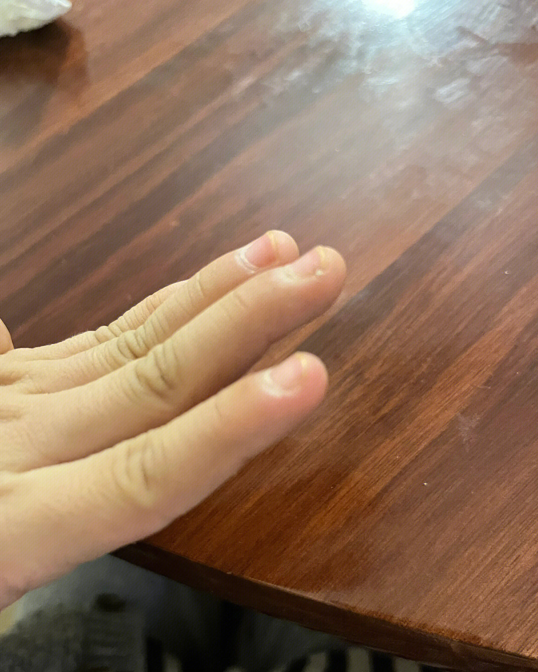 这是杵状指吗