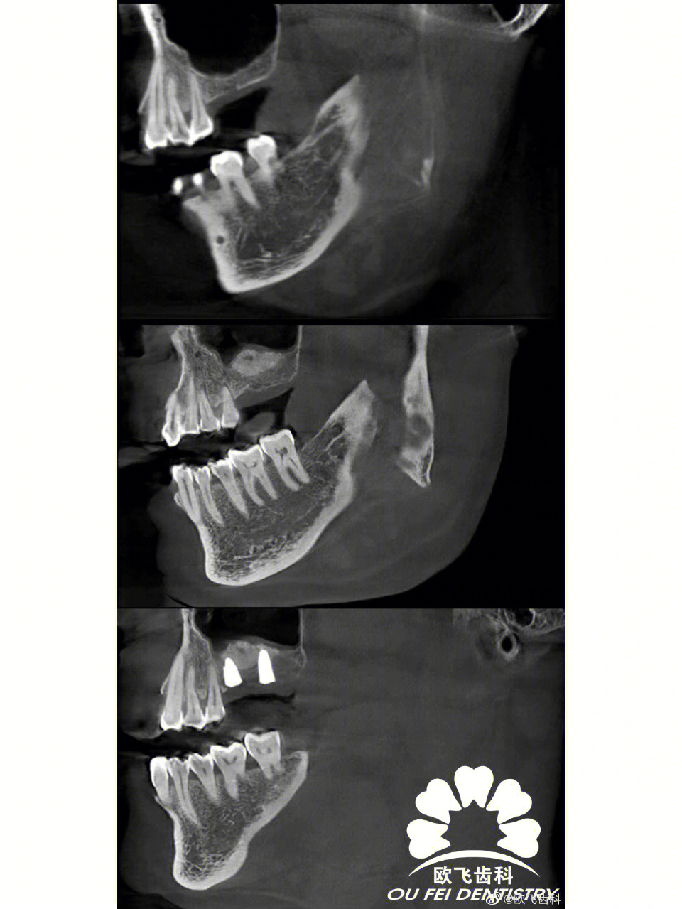 种植牙x片图片