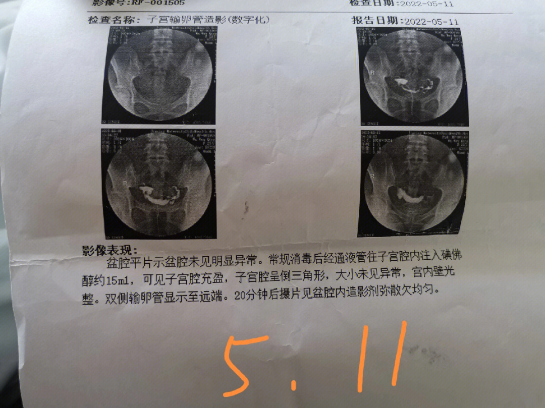 第二次宫外孕左边排卵结果右边宫外