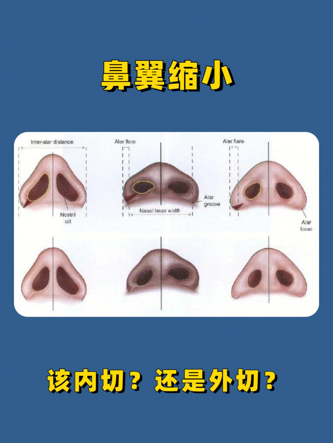 缩鼻翼内切图对比图片