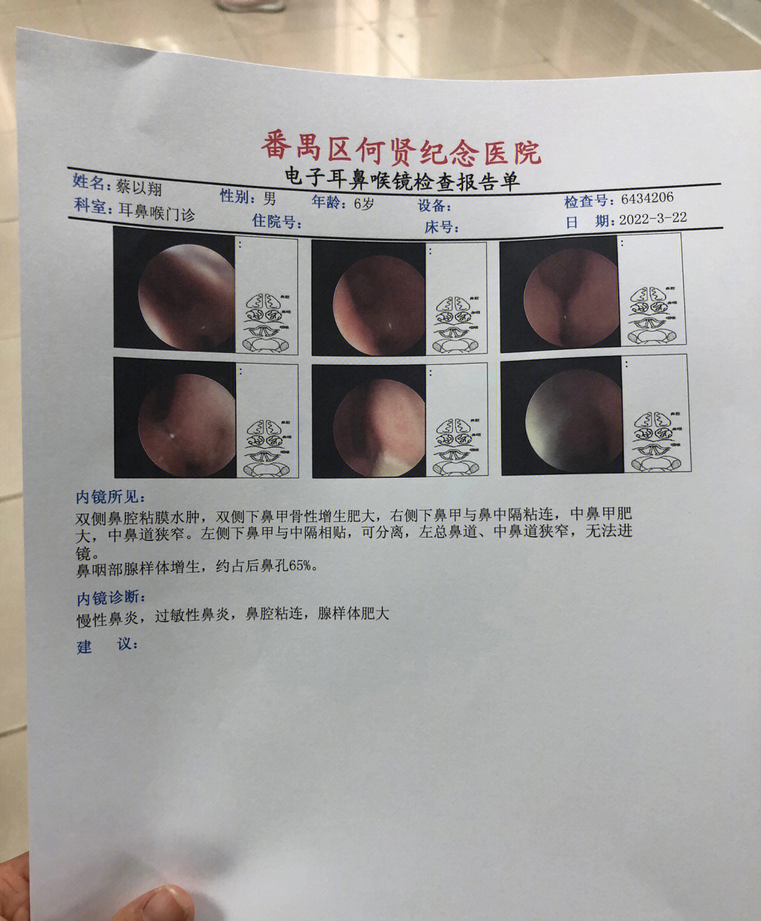 腺样体手术费用图片