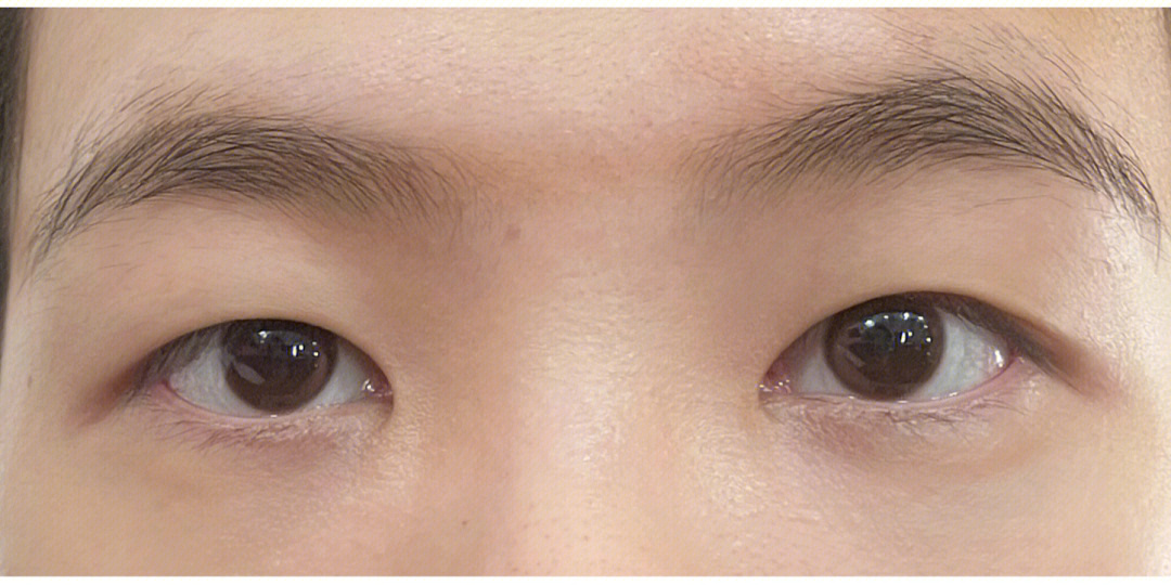 单双眼皮系谱图图片