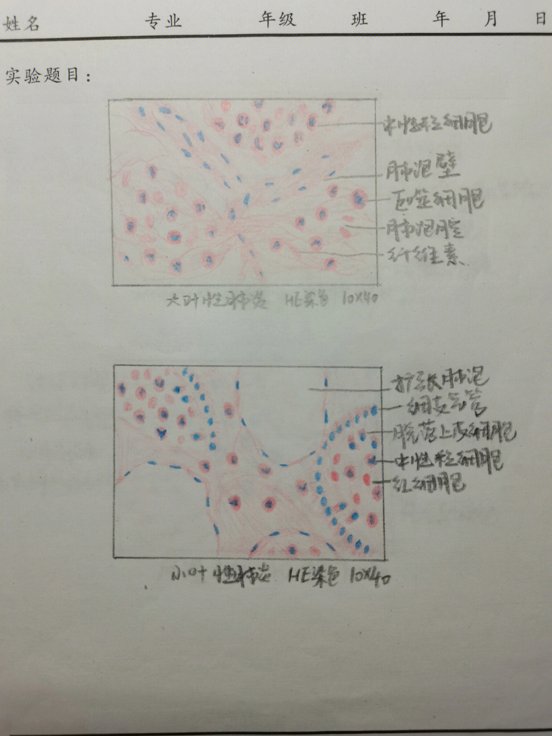 病理骨肉瘤红蓝手绘图片