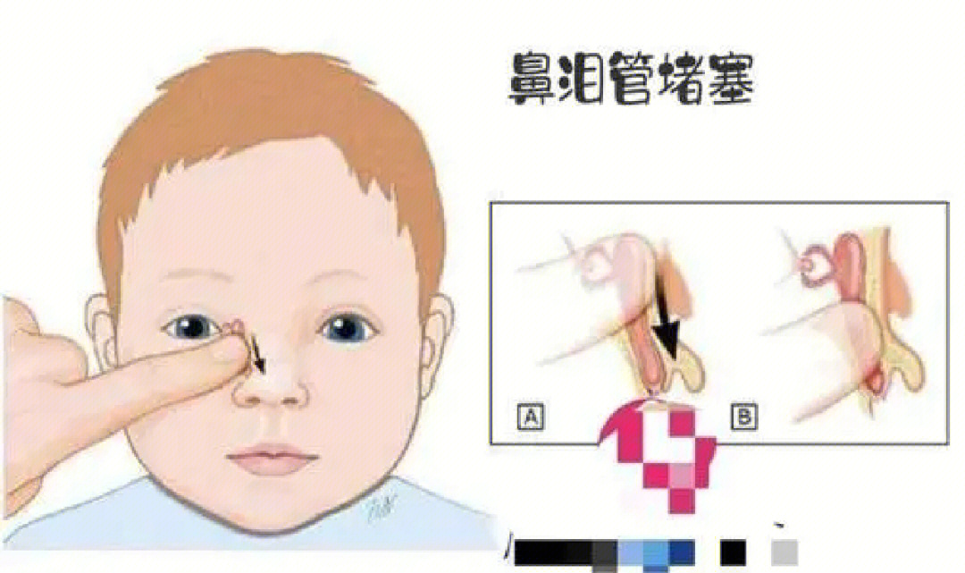 婴儿鼻泪管不通按摩图图片