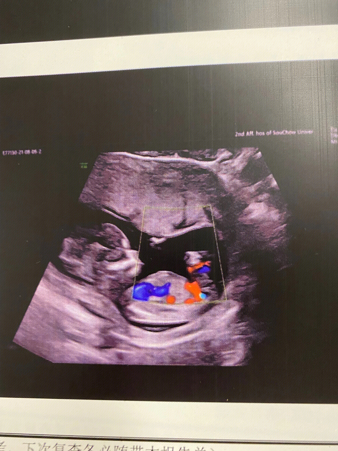 孕19周胎儿大小图片