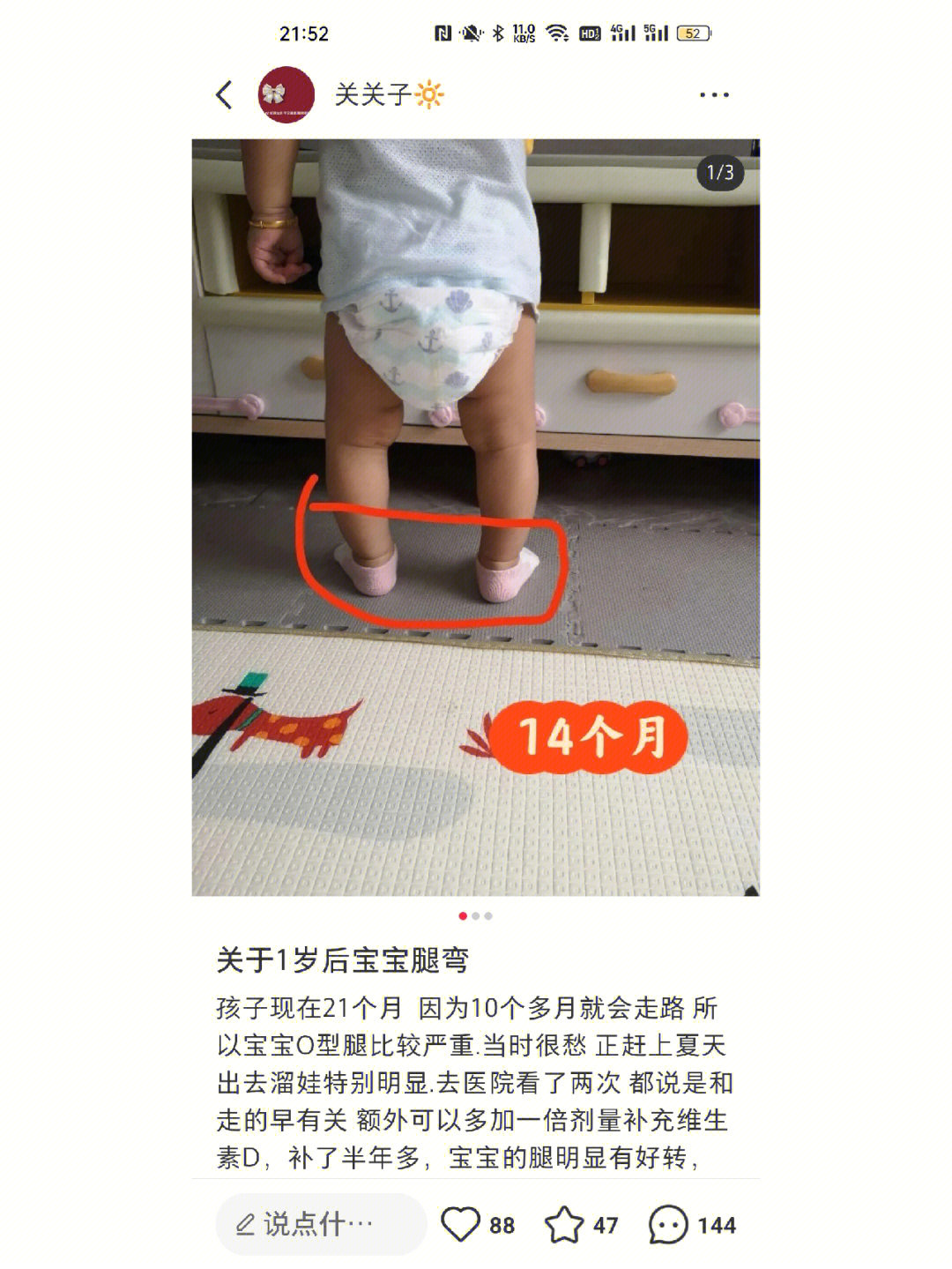 婴儿不正常腿型图4月图片