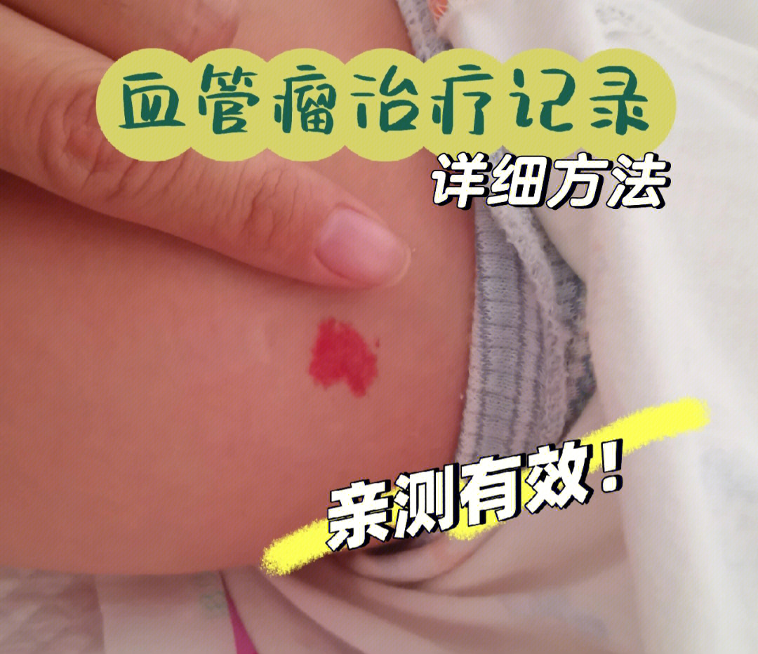 血管瘤查了很多帖子,并且在北京儿研所儿童医院线上问诊后开始给宝宝