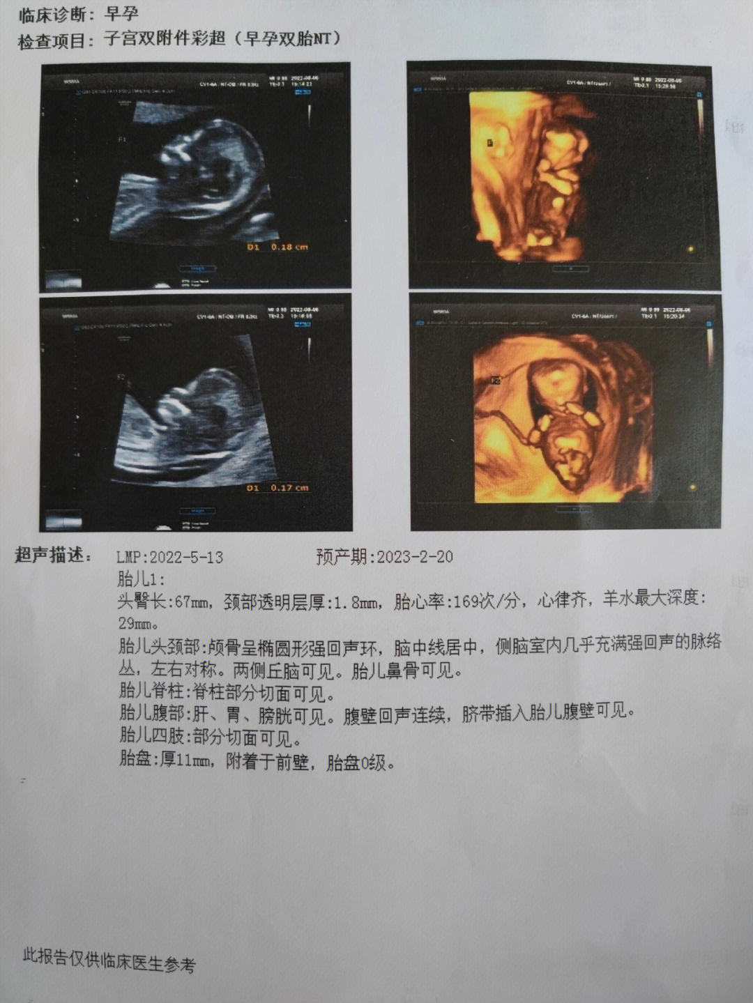 胎儿鼻骨短小图片