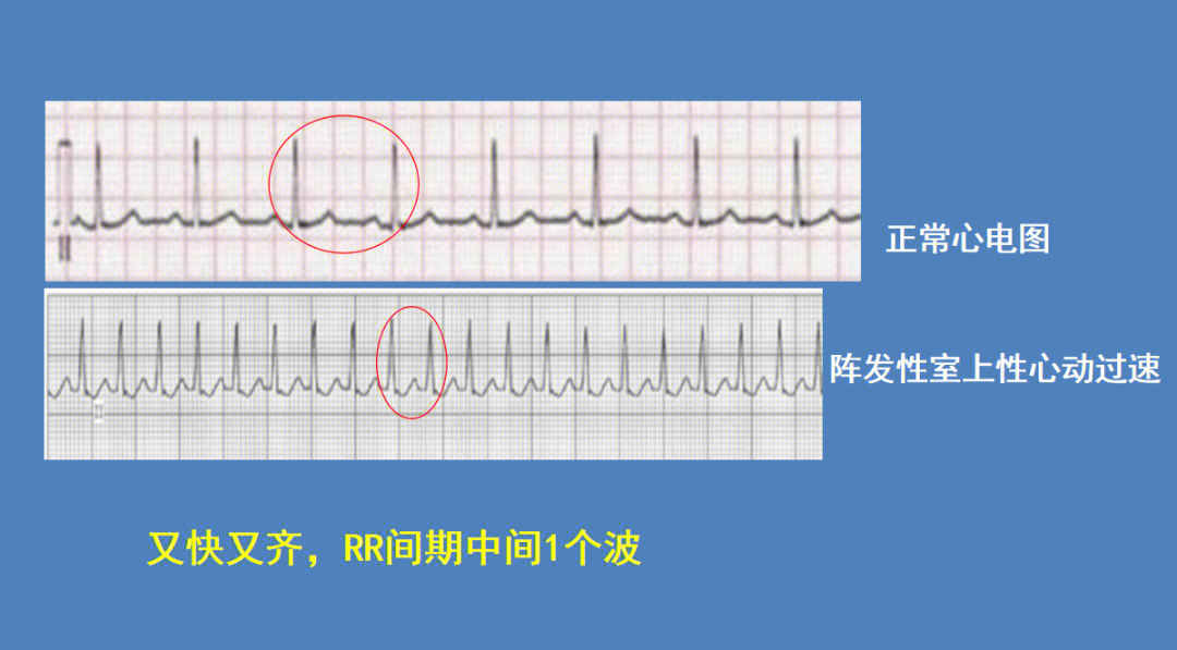 心电图很难,以下总结了正常心电图,窦性心动过速,窦性心动过缓,房性期