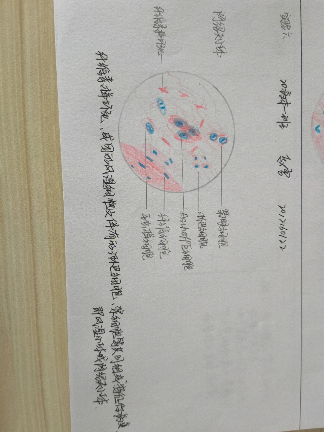 这么用心画的实验图怎么能不留下来呢阿绍夫小体大叶性肺炎鳞状细胞*