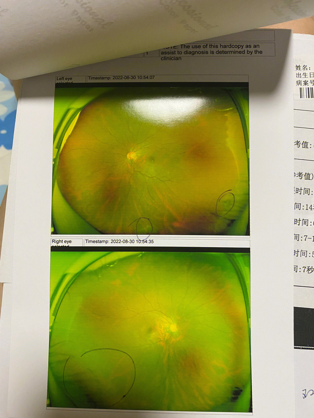 近视手术166近视15年25岁决定做近视手术