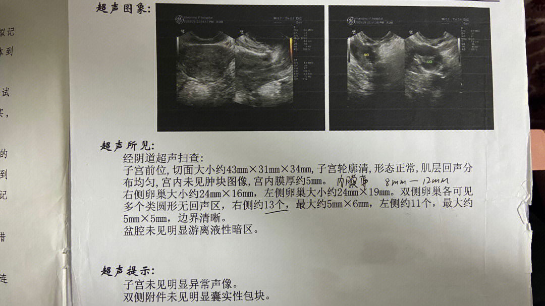 头顶多囊卵巢综合征的光环