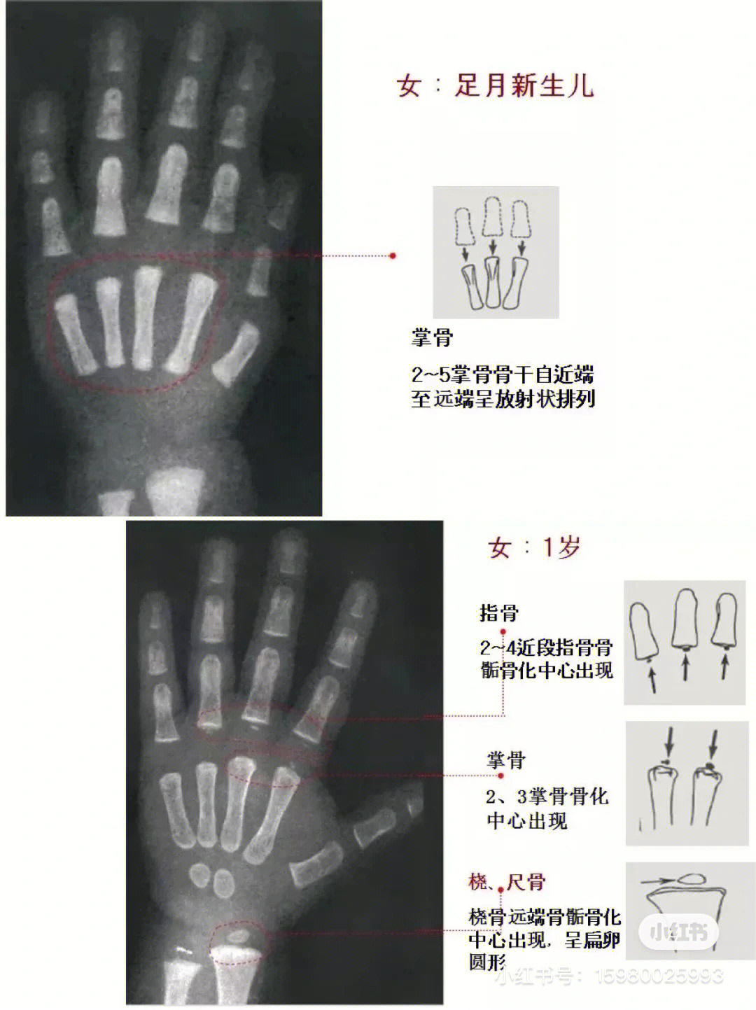 女童骨龄图谱