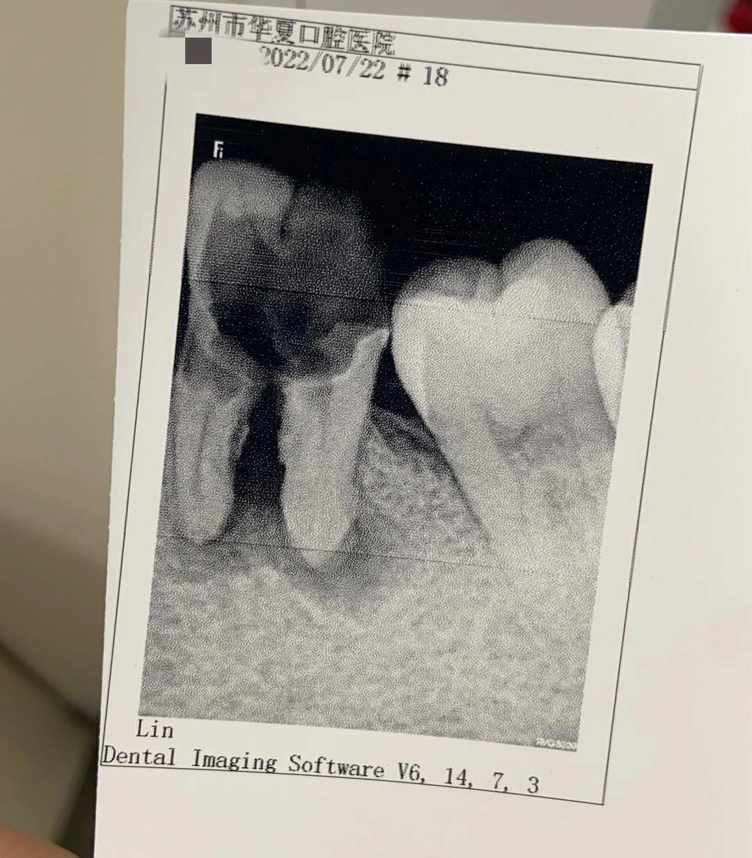 蛀牙x光片图片