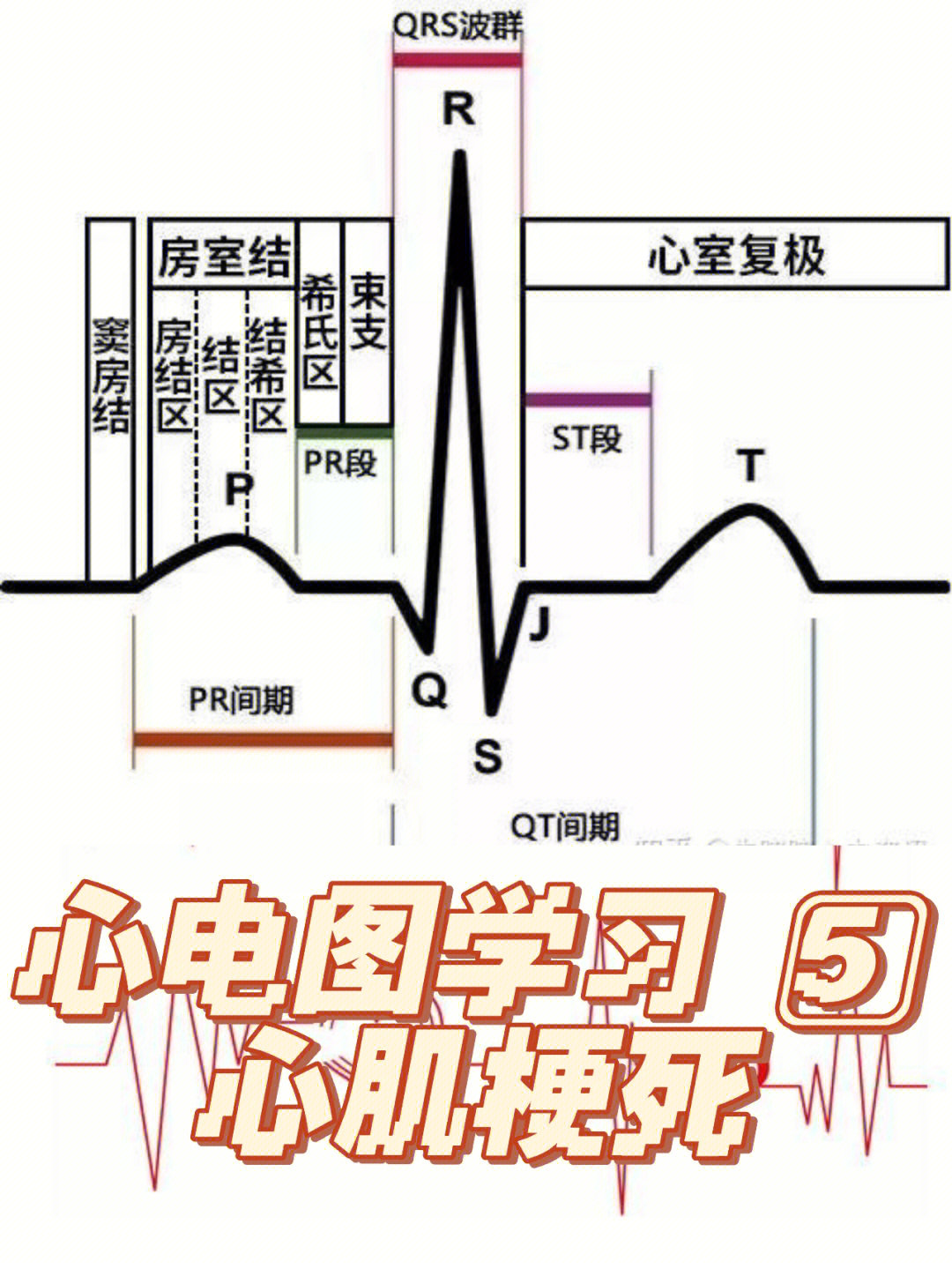 《一学就会心电图》的精简笔记总结04急性心肌梗死有三种变化:缺血