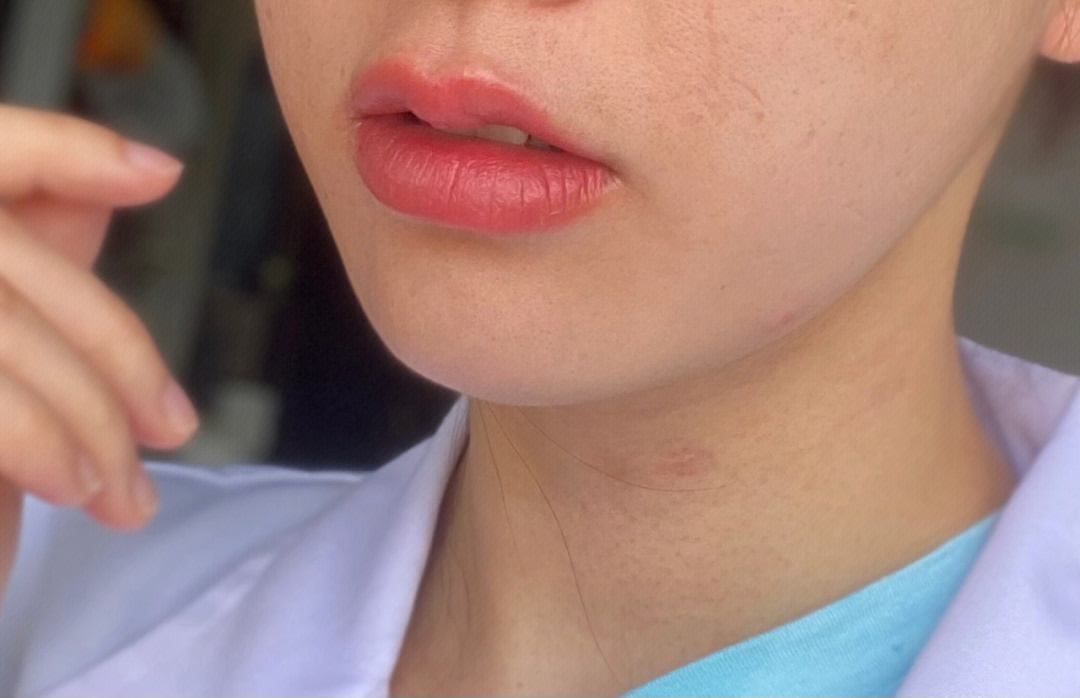 纹唇反色期过程图片图片