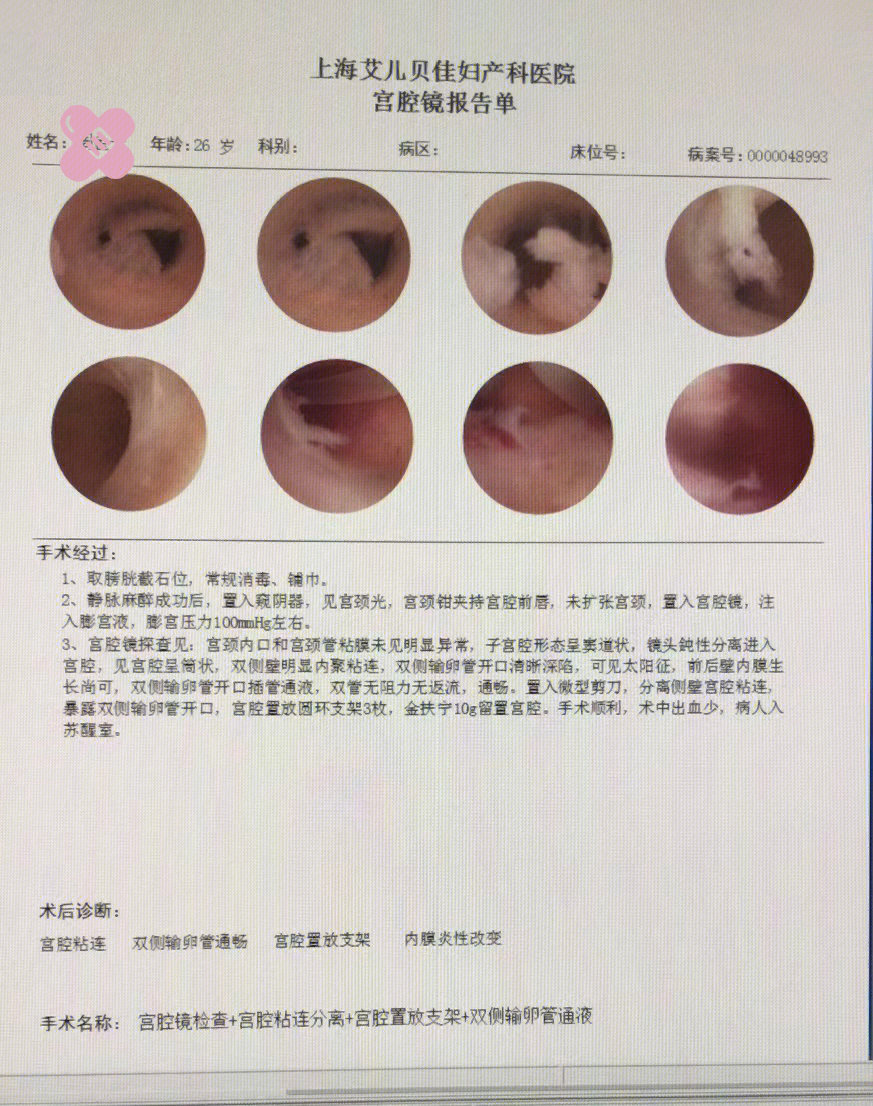 宫腔线分离图片