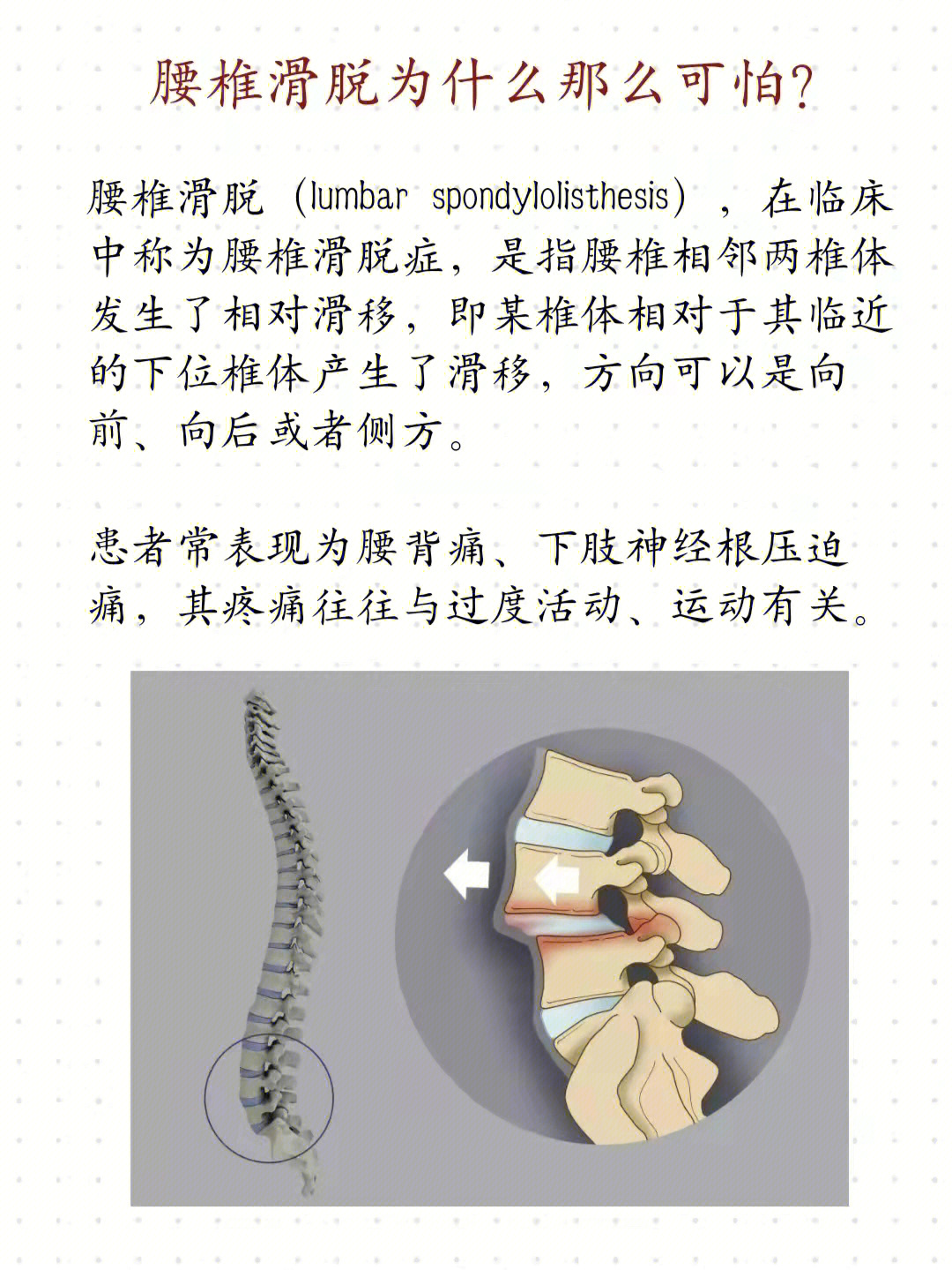 7~5%;在所有的腰椎滑脱中,由峡部崩裂引起的滑脱约占15%,退行性腰椎