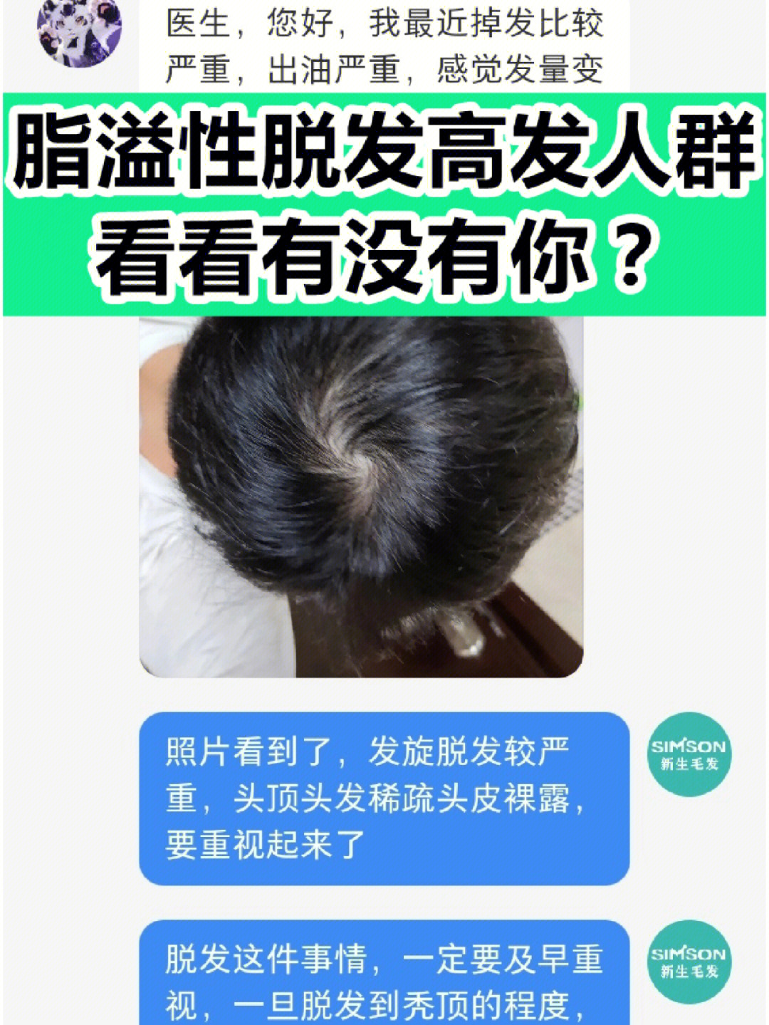 脂溢性脱发高发人群6015看看有没有你71