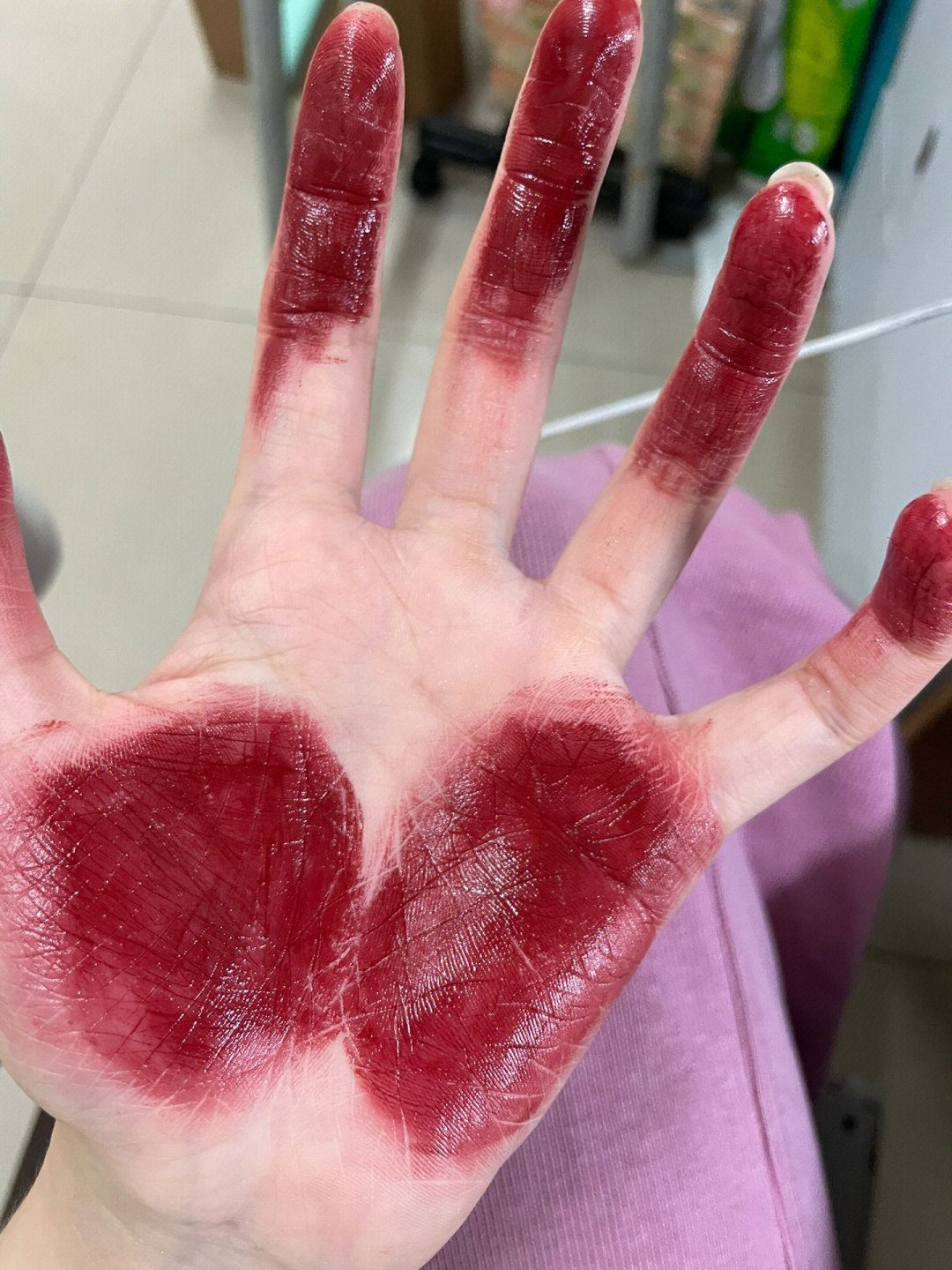 手指长红色血泡图片