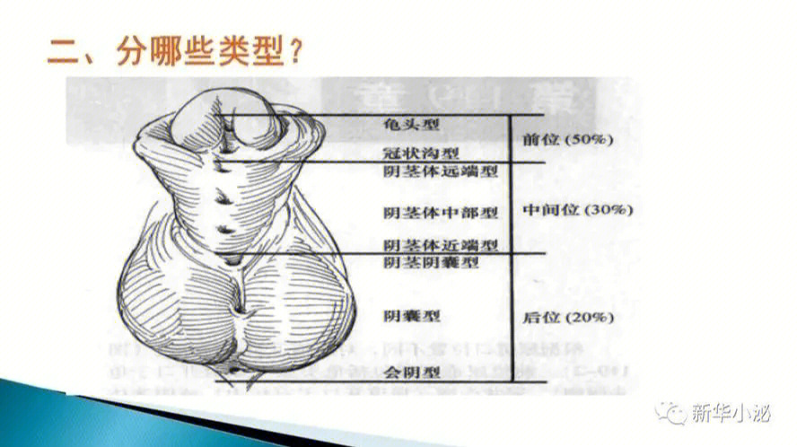 宝宝尿道下裂怎么办