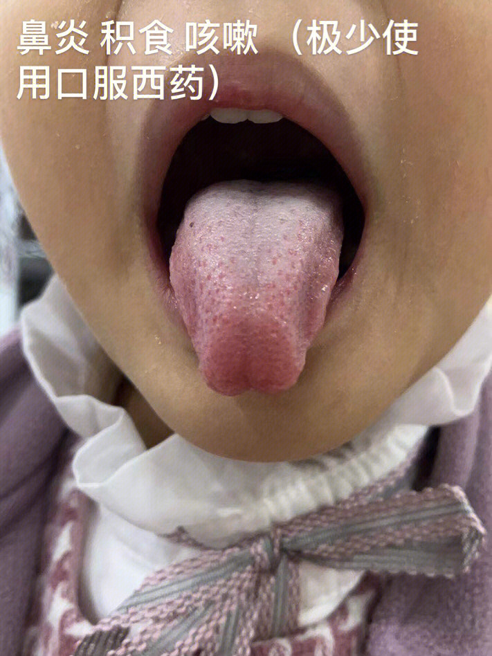 分享一些儿童鼻炎舌苔