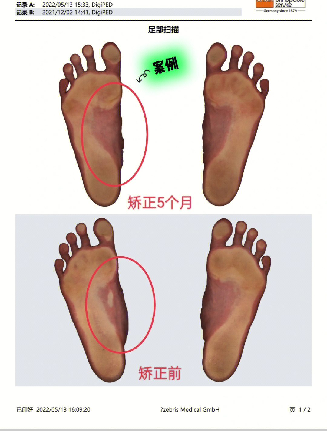 12岁男孩单侧平足足外翻5个月前后比较