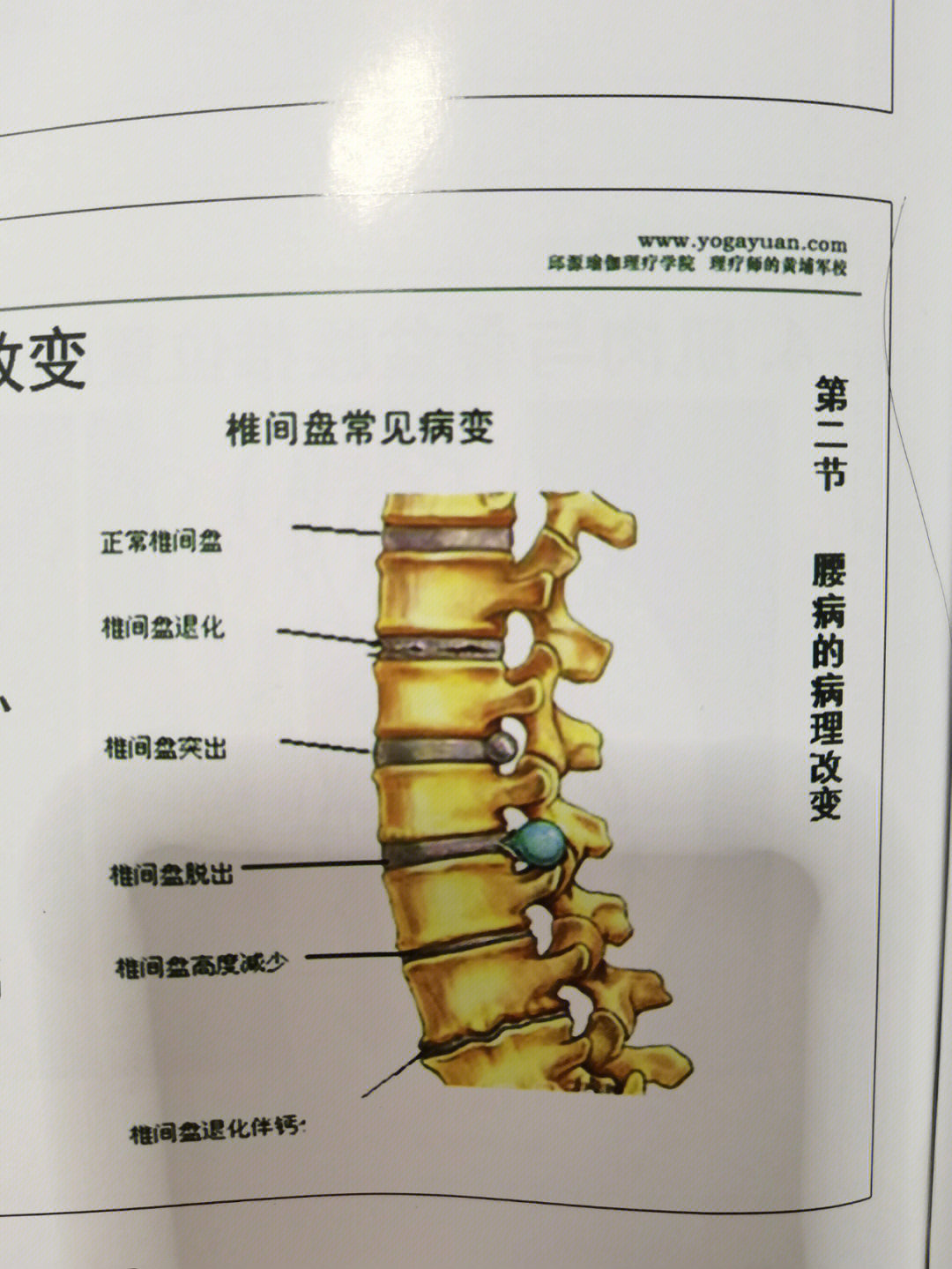 正常和不正常腰椎图片图片