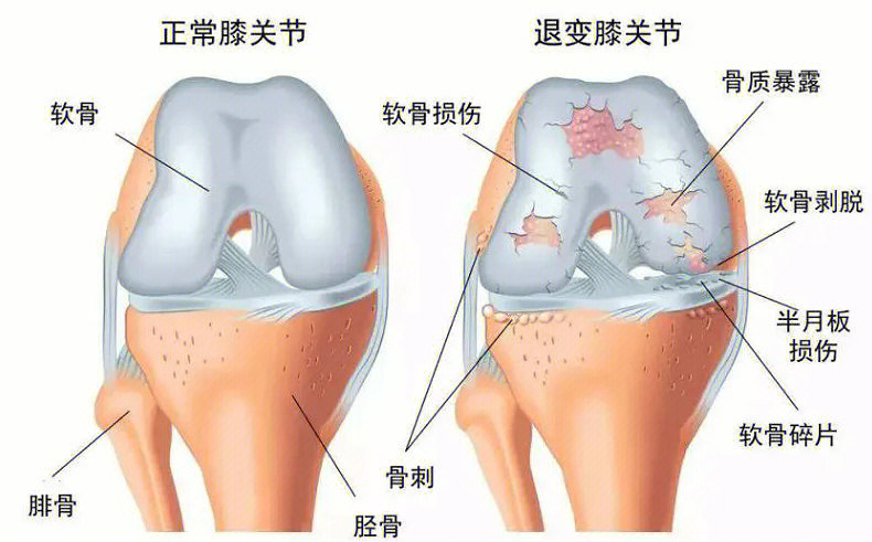 关节软骨的位置图片