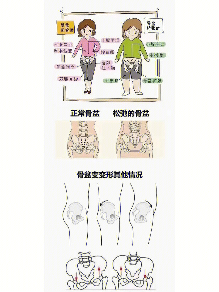 骨盆外扩有什么危害图片