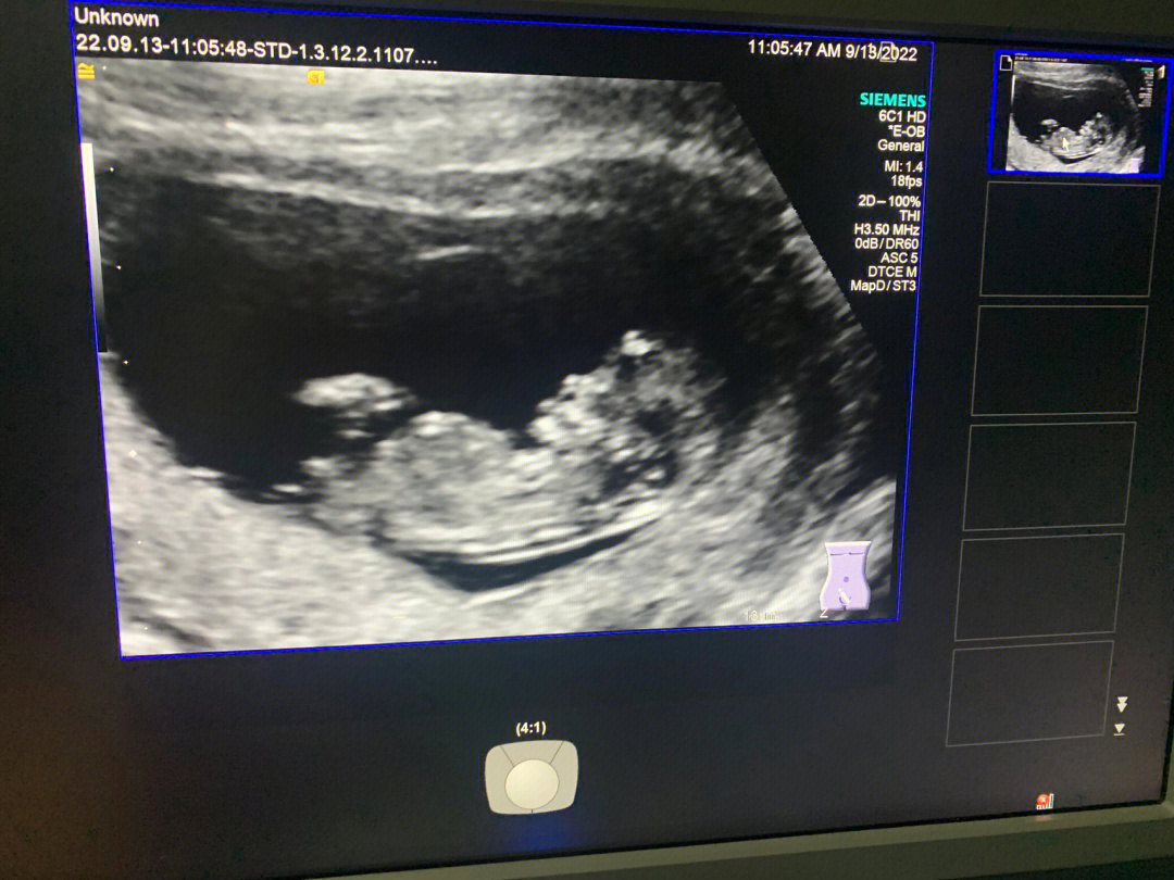孕11周宝贝已经是胎儿啦44cm