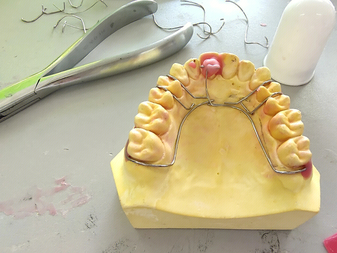 颌垫舌簧矫治器