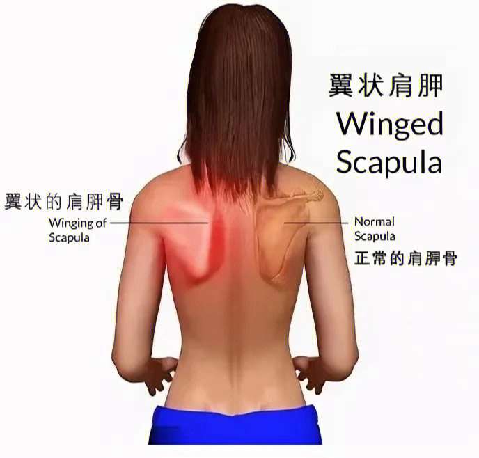 翼状肩胛睡姿图片