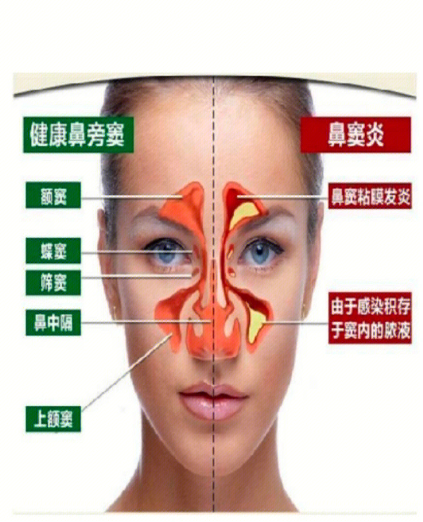 任何能堵塞鼻窦口的病因都有可能引起鼻窦炎,包括:过敏性鼻炎,抽烟,鼻