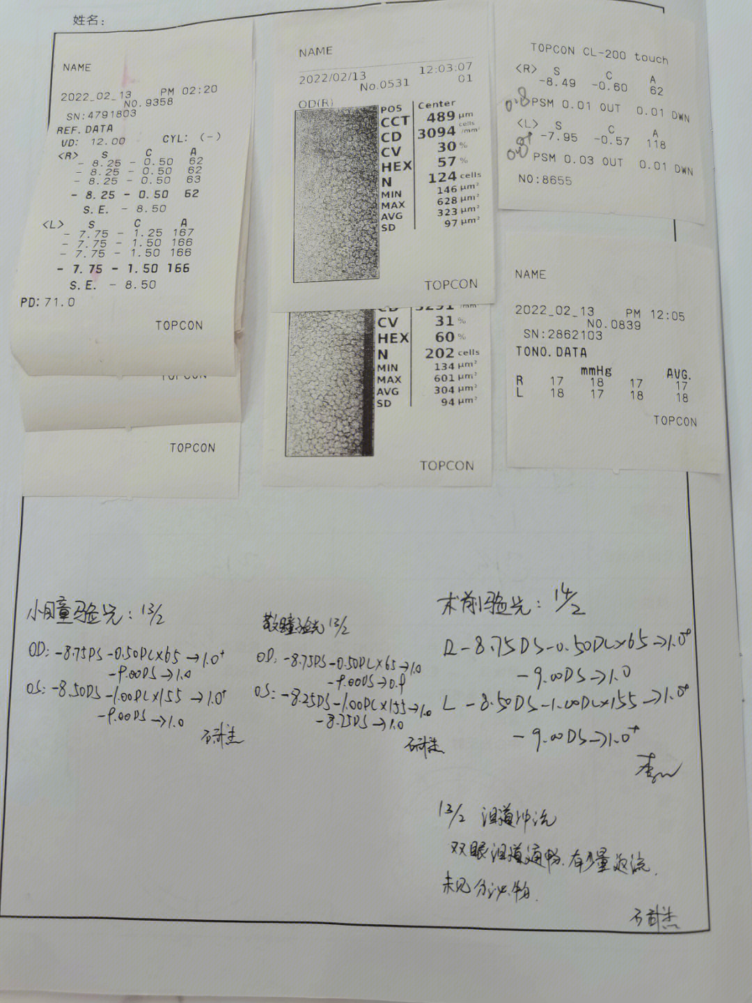 儿童角膜边缘灰色月牙图片