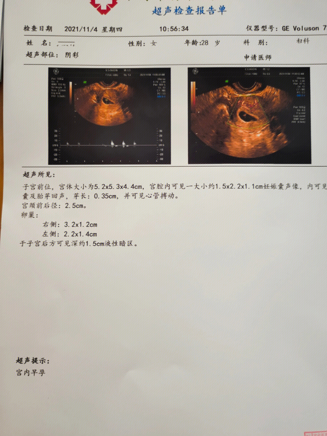 十七周胎心位置示意图图片