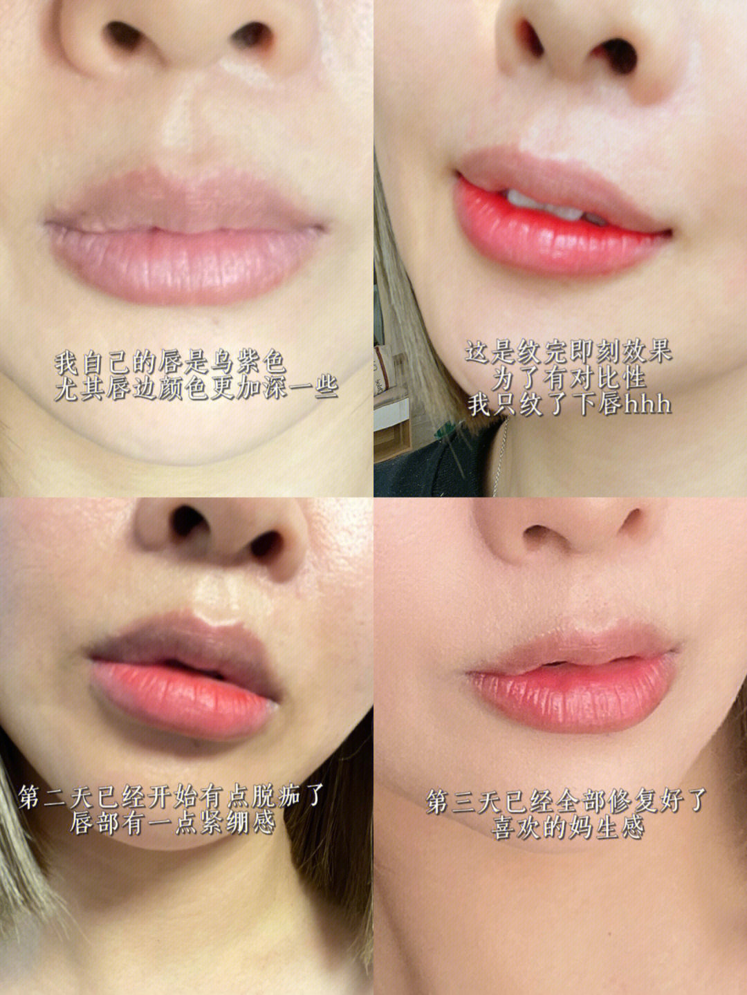 纹唇过程唇部修复过程分享给你们