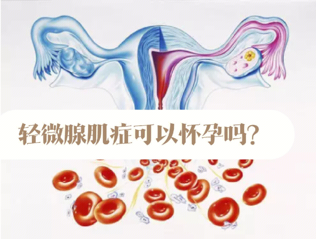 轻微腺肌症可以怀孕吗