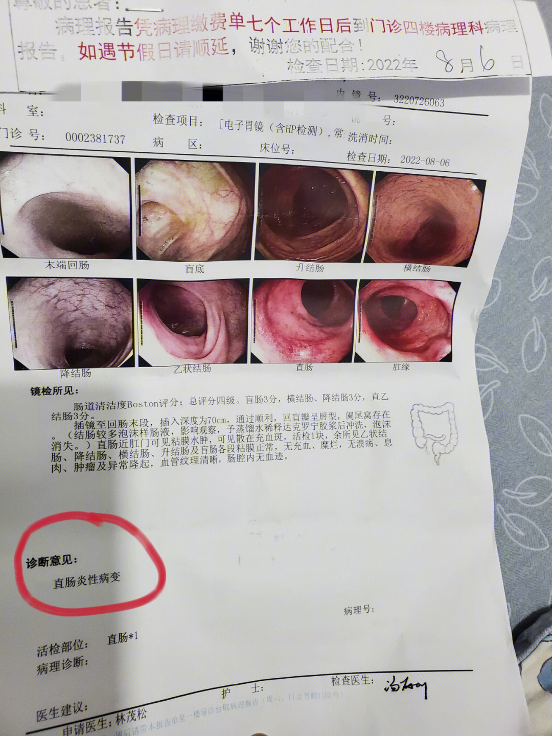 吃了四个月药去复查了这次做的是无痛肠镜