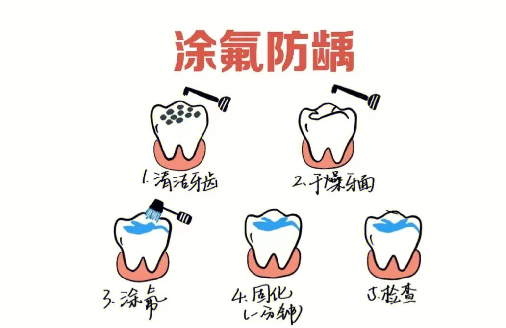 关于涂氟和窝沟封闭那些事儿