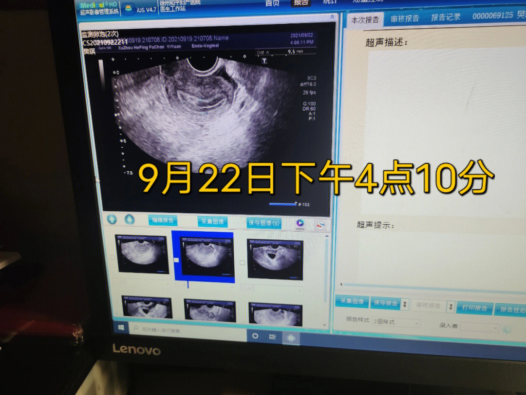 9月22日检测卵泡