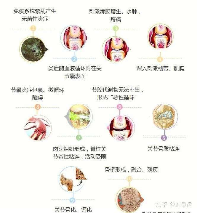 强直性脊柱炎的一些了解