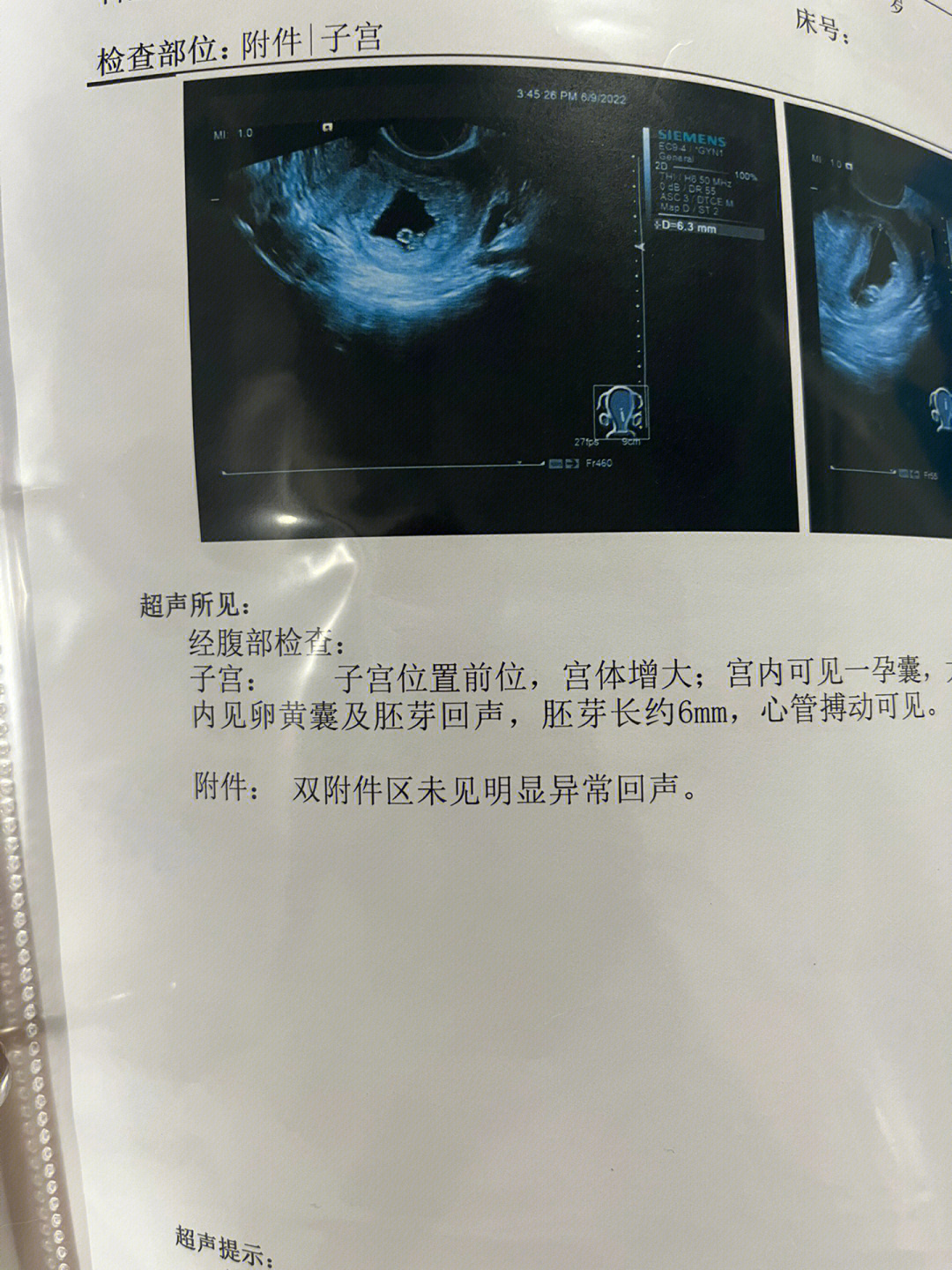 还愿了!孕七周没有胎心胎芽的姐妹不用害怕